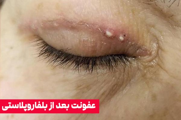 عفونت بعد از جراحی پلک