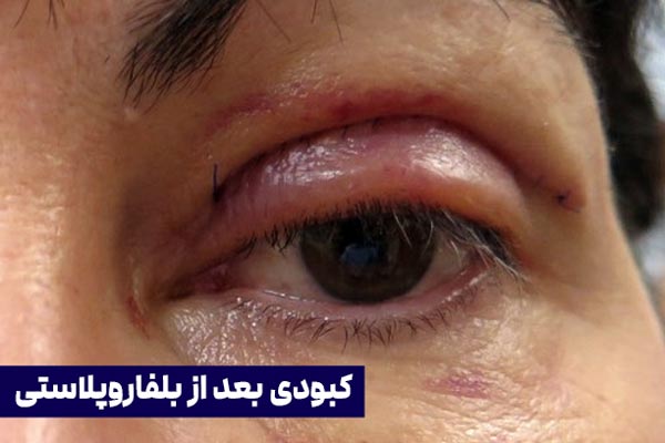 کبودی بعد از بلفاروپلاستی